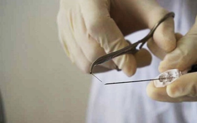 chữa xuất tinh sớm bằng phương pháp cấy chỉ