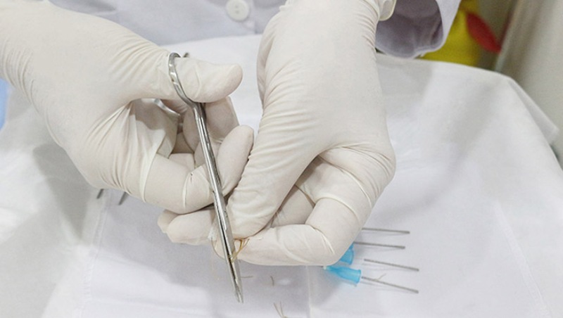 chữa xuất tinh sớm bằng phương pháp cấy chỉ