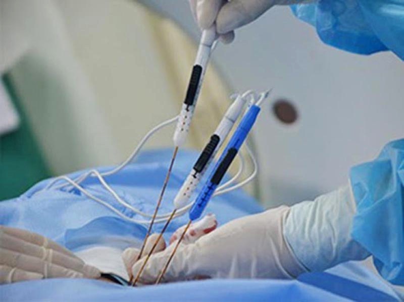 chữa xuất tinh sớm bằng phương pháp cấy chỉ