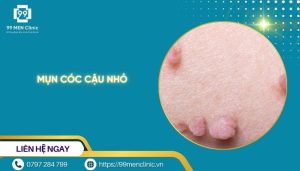 Mụn cóc cậu nhỏ