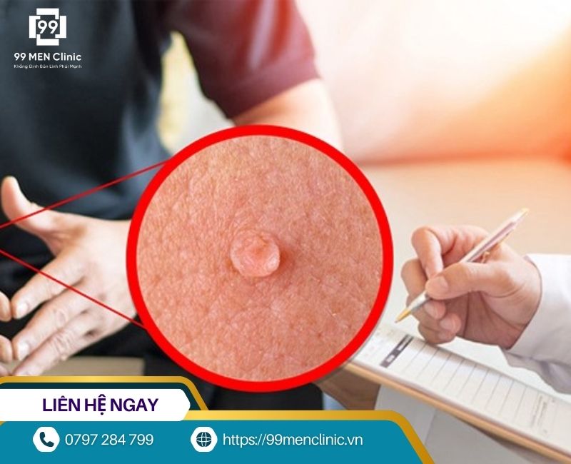 Mụn cóc dương vật ít khi biến mất