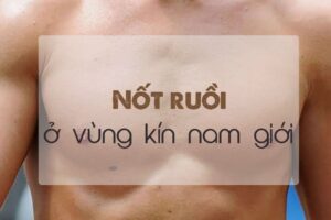 Nốt ruồi ở cậu nhỏ có nguy hiểm không