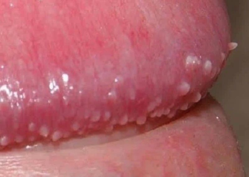 nốt ruồi ở cậu nhỏ