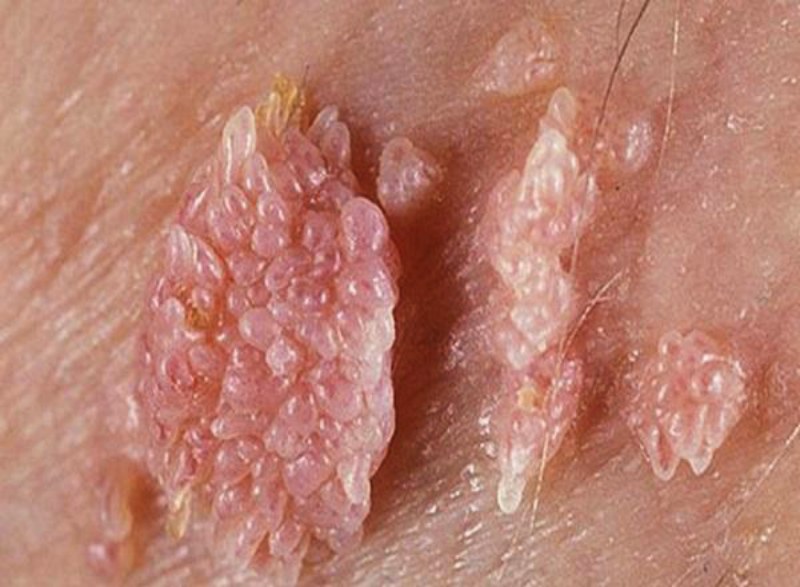 nốt ruồi ở cậu nhỏ