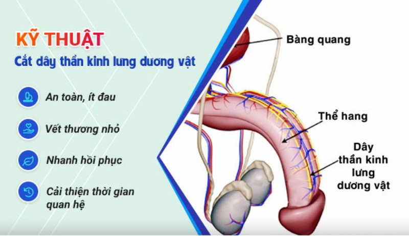 phẫu thuật trị xuất tinh sớm