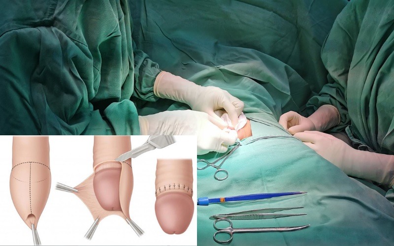 Cắt bao quy đầu để lại sẹo do cơ địa, di truyền, quá trình phẫu thuật, việc chăm sóc