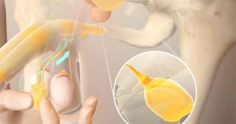 Phương pháp phẫu thuật cấy vật hang giả chữa rối loạn cương dương