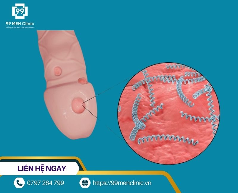 Bệnh tình dục cũng là nguyên nhân khiến dương vật ngứa rát, gãi gây trầy xước