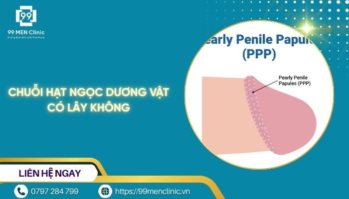 Chuỗi hạt ngọc dương vật có lây không