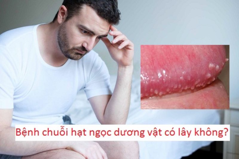 chuỗi hạt ngọc dương vật có lây không