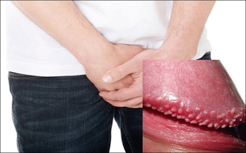 chuỗi hạt ngọc dương vật có tự hết không