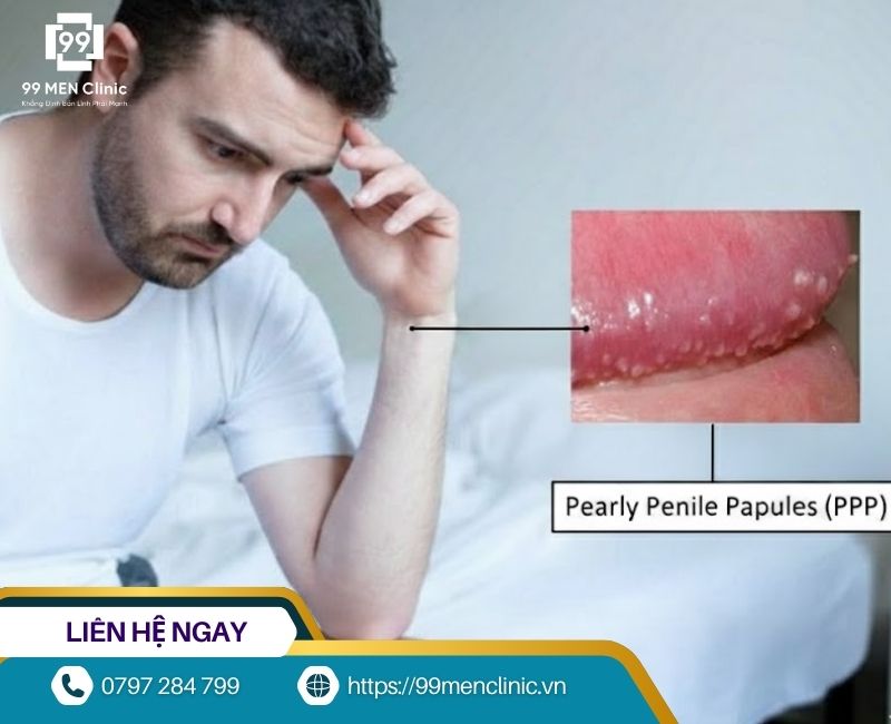 Chuỗi hạt ngọc dương vật không lây