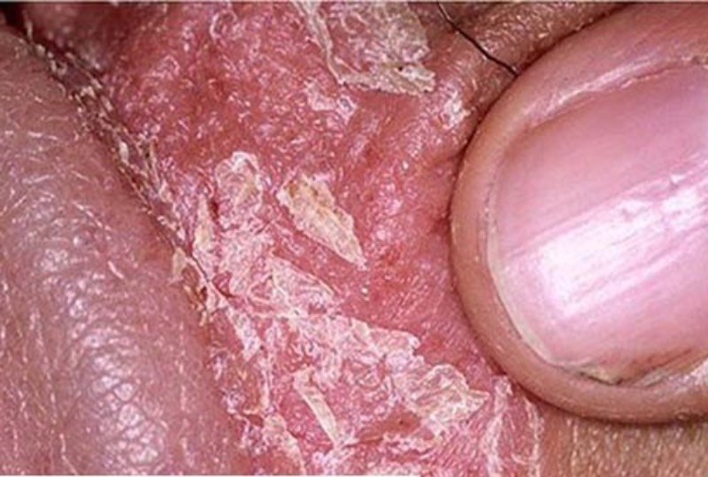 da dương vật bị khô