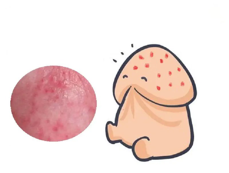 đầu dương vật bị thâm