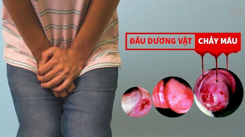 đầu dương vật bị thâm
