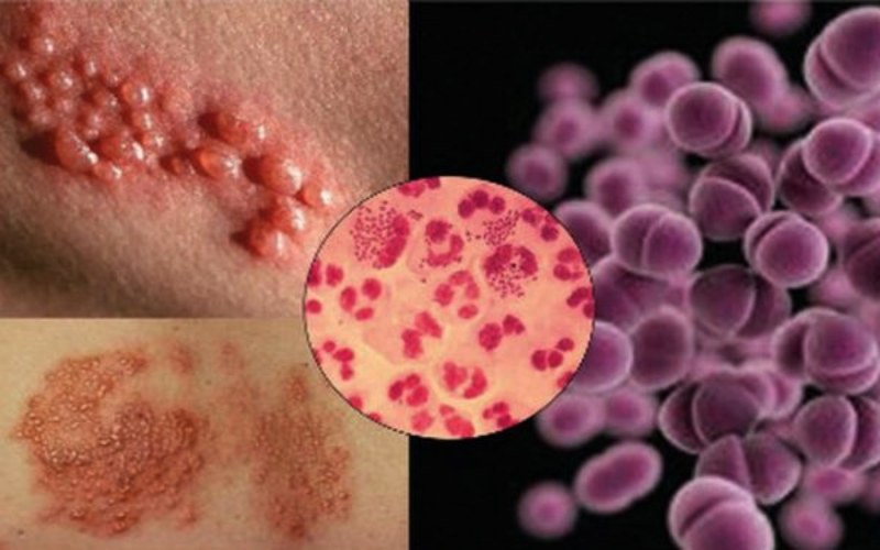 đầu dương vật bị thâm