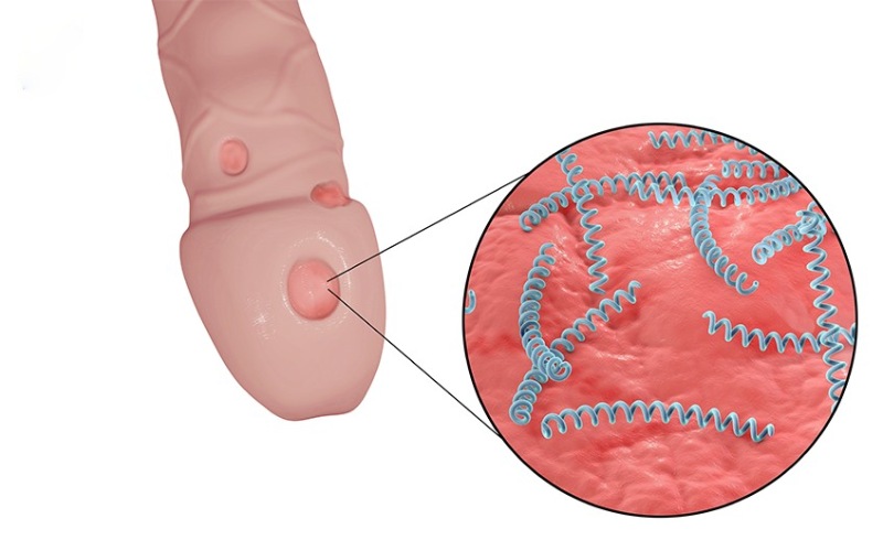 dương vật bị xước