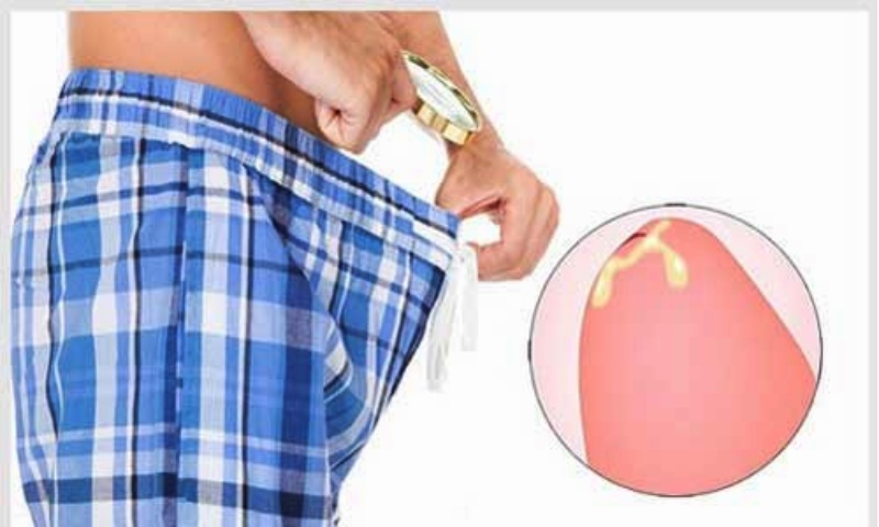 dương vật chảy mủ trắng đục