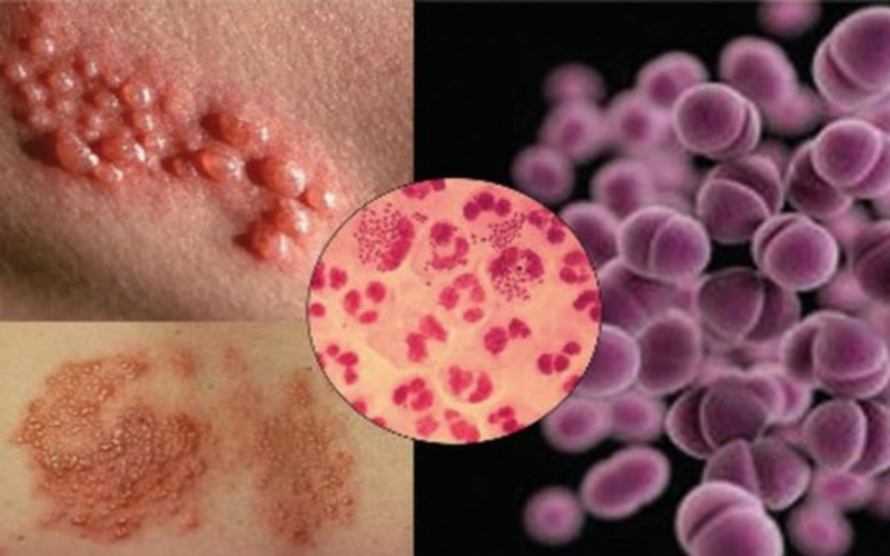 dương vật chảy mủ trắng đục