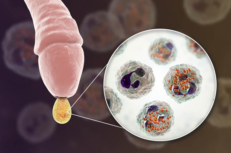 dương vật chảy mủ trắng đục