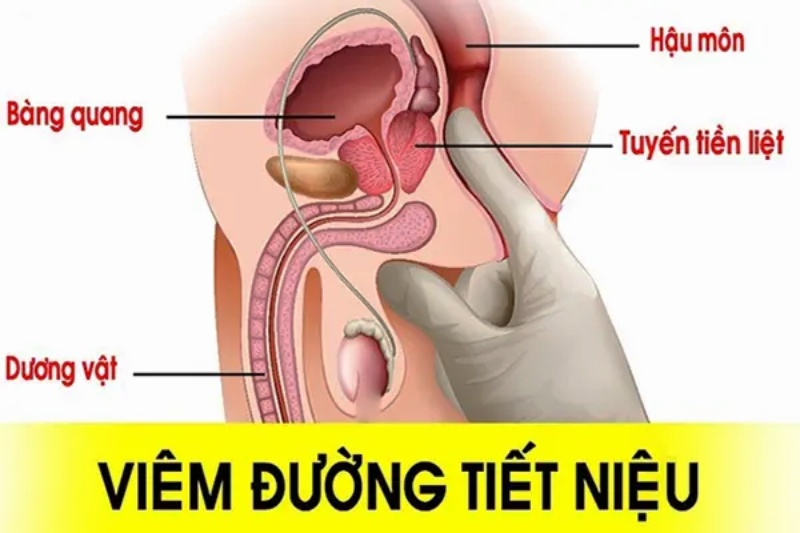 dương vật chảy mủ trắng đục