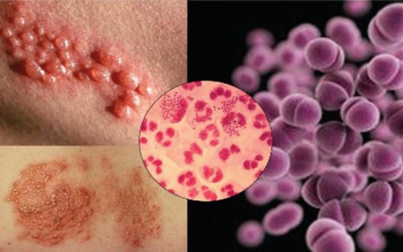 Bệnh lậu và các bệnh tình dục khác khiến sưng dương vật