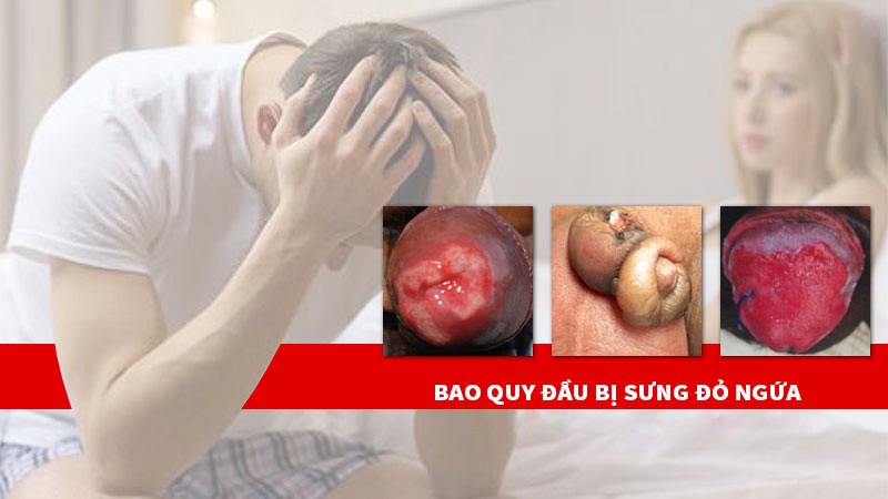 Dương vật sưng với biểu hiện ngứa rát, đau và có dịch mủ nên đi khám