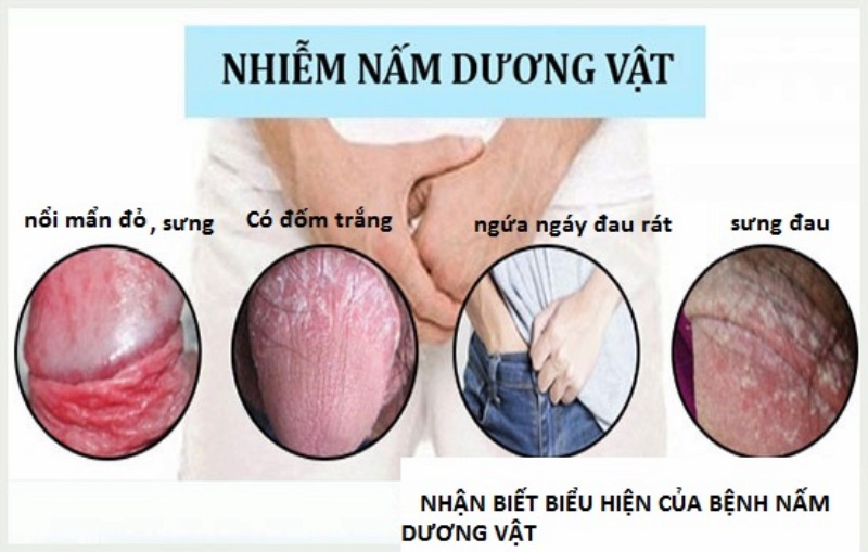 Biểu hiện nấm dương vật khá dễ nhận biết