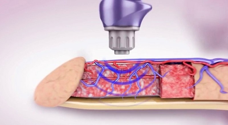 trị xuất tinh sớm bằng sóng cao tần