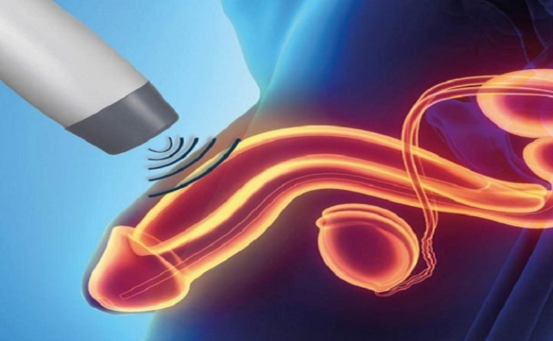 trị xuất tinh sớm bằng sóng cao tần