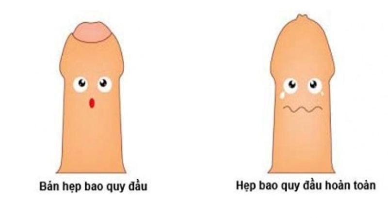 Bao quy đầu hẹp làm tăng nguy cơ bị viêm nhiễm