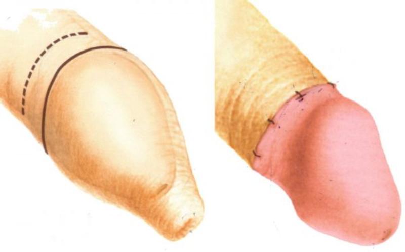 Phần da bao quy đầu bao trùm toàn bộ dương vật và lỗ niệu đạo