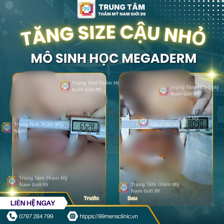 Kết quả nâng size cậu nhỏ bằng megaderm