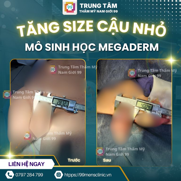 Tăng kích thước bằng megaderm