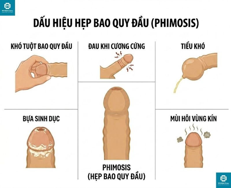 Dấu hiệu hẹp bao quy đầu