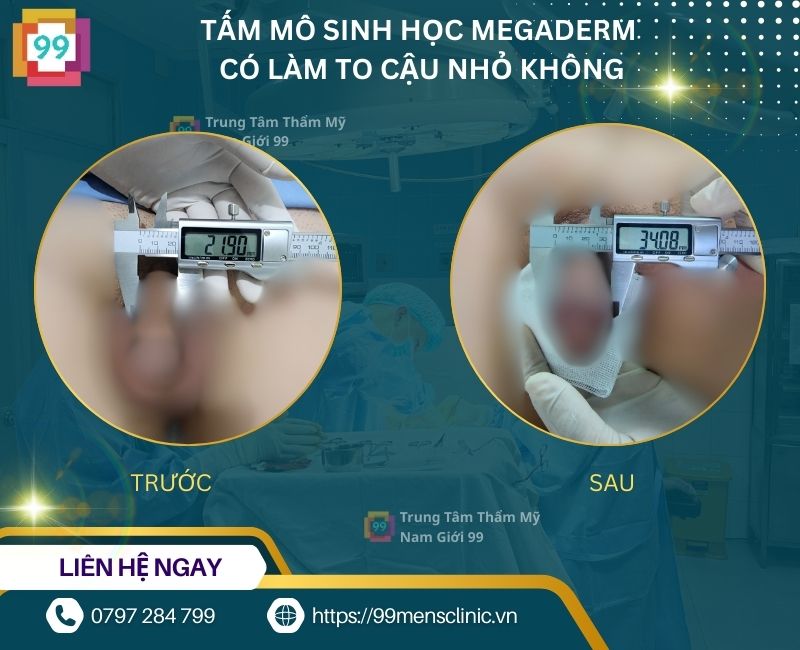 Tấm mô sinh học megaderm có làm to dương vật không