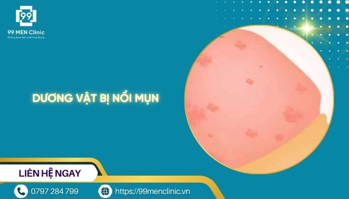 Dương vật bị nổi mụn