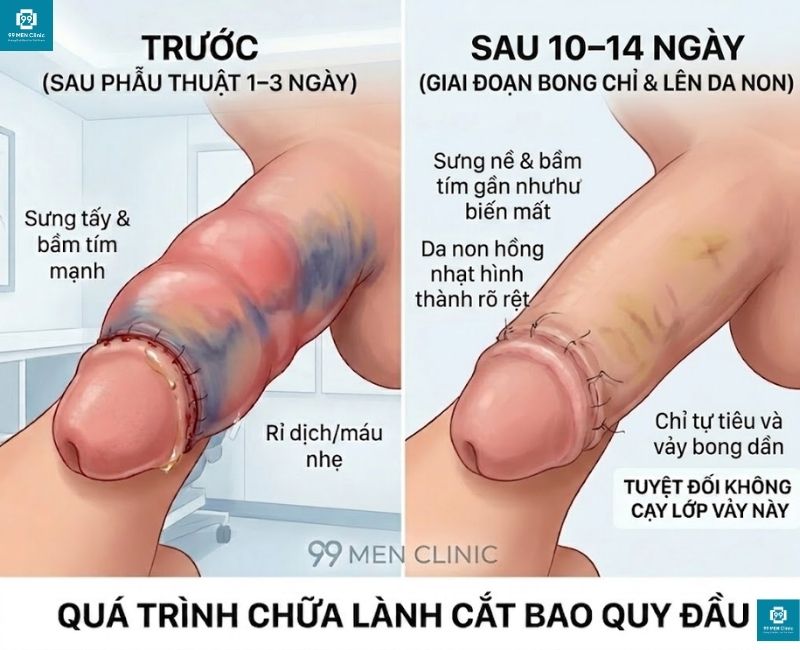 Lớp da non tái tạo, ghim stapler bắt đầu tự rụng khỏi rãnh quy đầu