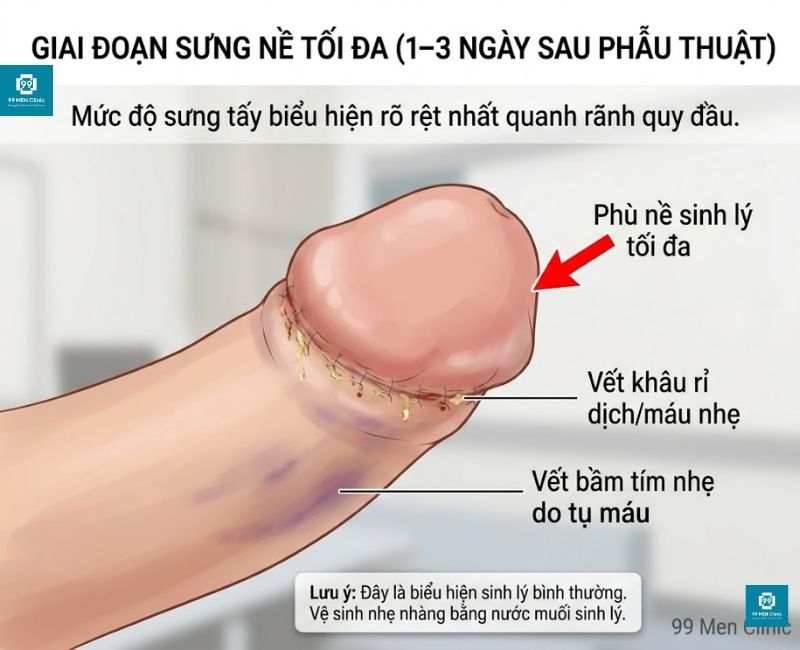 Hình ảnh vùng phù nề sinh lý trong 3 ngày đầu tiên