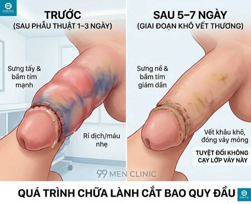 Vết khâu bắt đầu se lại, bề mặt xuất hiện lớp vảy non bảo vệ