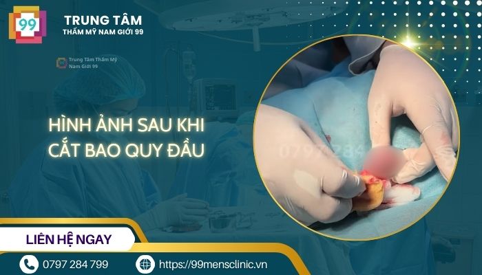 Hình ảnh sau khi cắt bao quy đầu