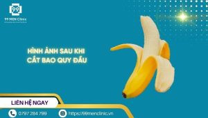 Hình ảnh sau khi cắt bao quy đầu