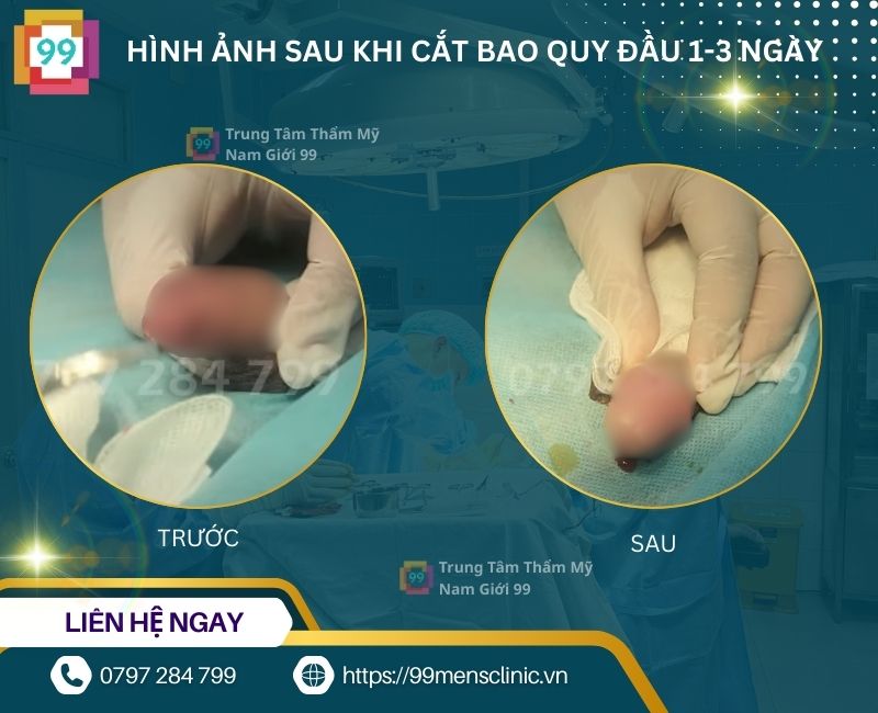 Hình ảnh sau khi cắt bao quy đầu 1 ngày