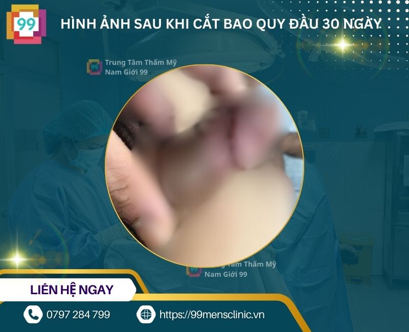 Hình ảnh sau khi cắt bao quy đầu 30 ngày