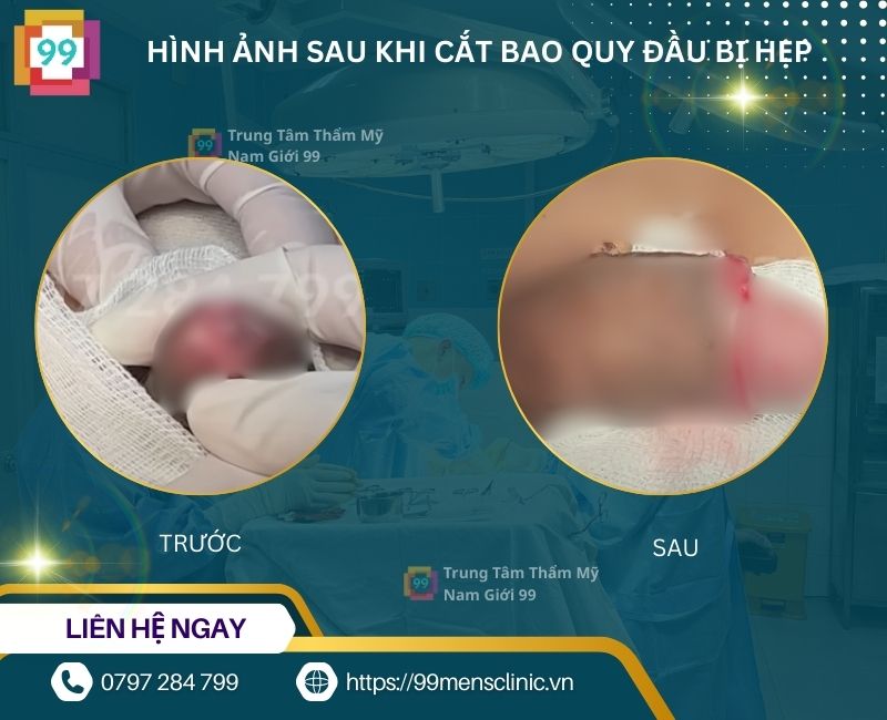 Hình ảnh sau khi cắt bao quy đầu bị hẹp