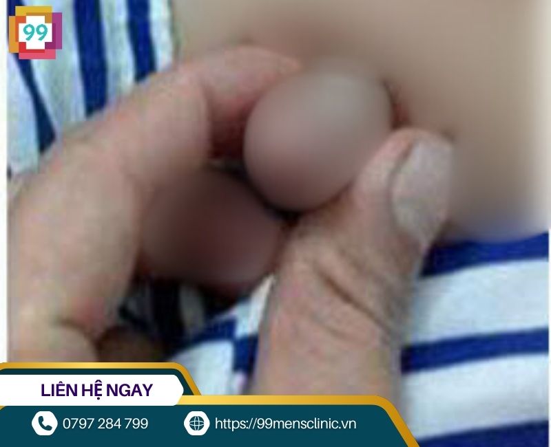 Hình ảnh viêm bao quy đầu ở trẻ nhỏ bị biến chứng