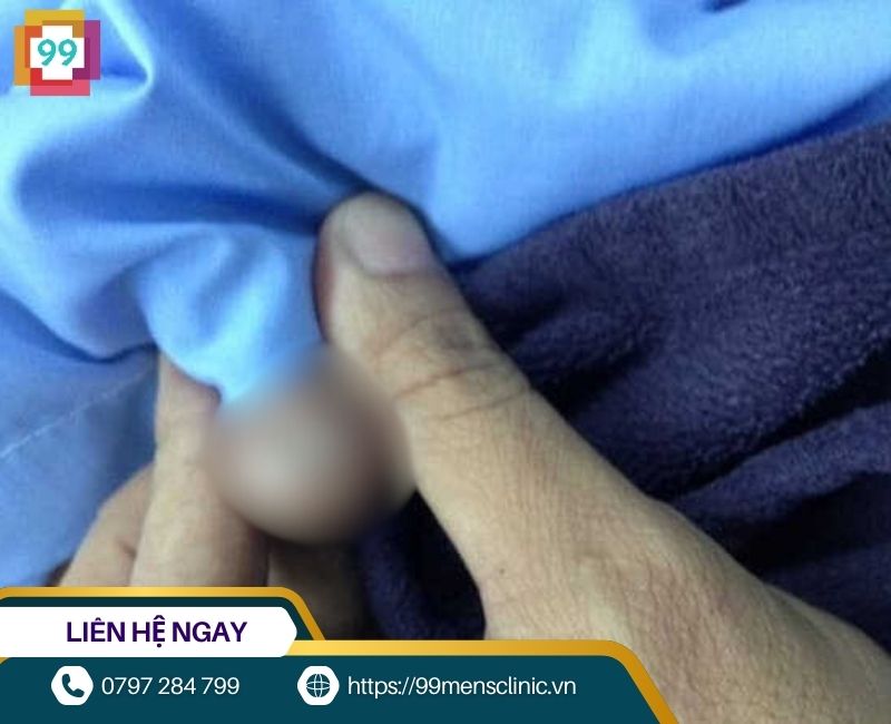 Hình ảnh viêm bao quy đầu ở trẻ nhỏ giai đoạn nặng