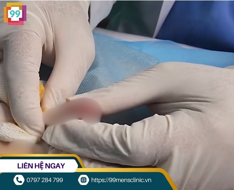 Hình ảnh viêm bao quy đầu ở trẻ nhỏ giai đoạn nhẹ