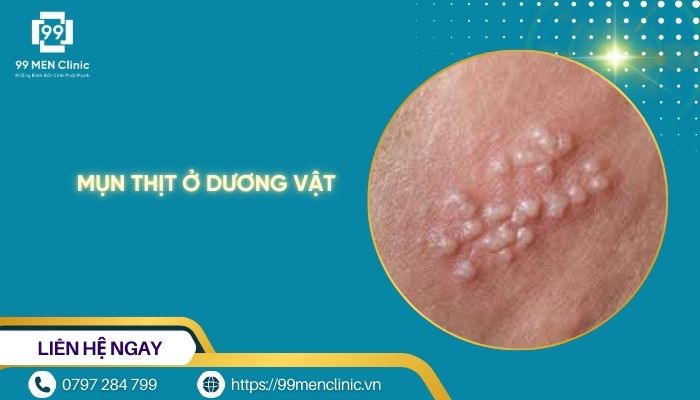 Mụn thịt ở dương vật