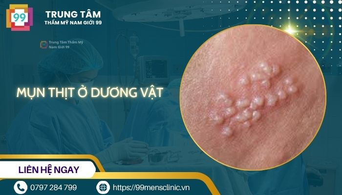 Mụn thịt ở dương vật